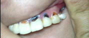 牙坏了图片,牙齿损坏的警示与护理之道